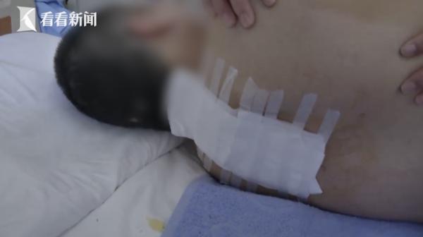 女子上班时从12楼坠落全身多处骨折 公司老板付了1万3失联