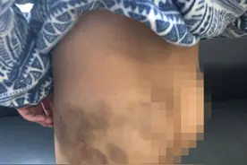 33岁男子多次殴打双胞胎儿子致下肢大面积淤青，被批捕图片