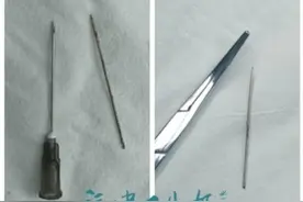 神操作！福建男子用绣花针自行针灸，结果断在体内了图片