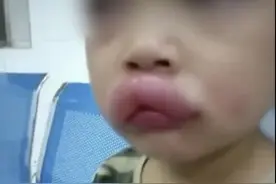 娃吃葡萄过敏，嘴唇嘟嘟，亲爹：虽然心疼但太好笑了图片
