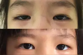 6岁女童从小“眯眯眼”，因自卑一度寡言少语，二次手术后重拾自信图片
