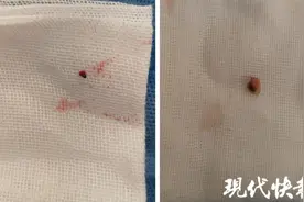 两颗米粒大的铁屑，差点要了六旬大爷的命图片