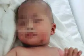 女婴被烫伤外公用高度白酒敷 称可减少孩子的疼痛感图片