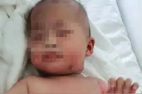 女婴被烫伤外公用高度白酒敷 称可减少孩子的疼痛感图片