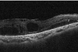 看东西会放大、变形，大爷惊现“超能力”？医生：是眼睛黄斑长“膜”了图片