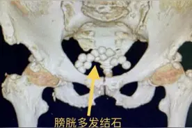 98岁抗战老兵膀胱长满结石 南京鼓楼医院团队妙手解除病痛图片