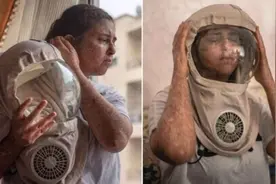 对紫外线过敏导致退学 英国28岁女子出门必须戴防护面具图片