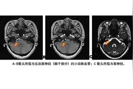 脸部抽搐毁“面子”微创手术一次解除“面部痉挛”图片