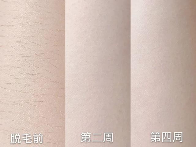 激光脱完毛后可以涂身体乳吗