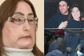 美国首位换脸人去世 年仅57岁 曾被丈夫散弹枪轰脸留下“狰狞”面容图片