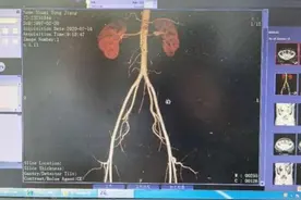 贵州小伙14岁患高血压！医生仔细一查，取出他的肾换了个位置……图片