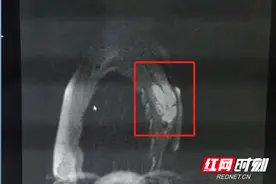 疼痛忍忍就好？警惕背后隐藏的恶性肿瘤图片