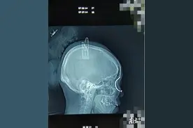 惊悚！佛山一妇女工作时不慎被8cm生锈铁钉穿眼图片