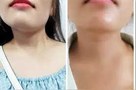 小手术助她告别32年的“歪脖子”生活——娄底市中心医院成功运用微创手术治愈一例先天性斜颈患者图片