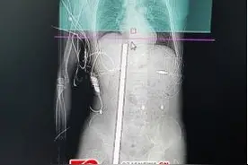 险！男子钢筋贯穿身体 术后奇迹生还图片