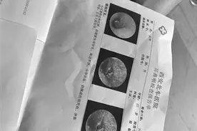西安男子疑因采耳致鼓膜穿孔 医生：耳朵有自洁功能 没必要清理图片