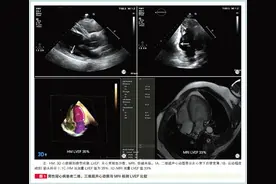 评估心功能，心脏超声三维成像效果堪比磁共振！阜外王浩团队经验图片