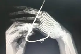 看着都痛！男子海钓时鱼钩扎进右手心图片