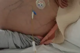 我有坚强活下去的勇气！贵州“巨肚”妈妈4天“瘦身”20斤，仍在住院观察图片