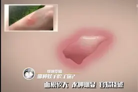 到底是哪种蚊子咬了你？看“形状”就知道图片