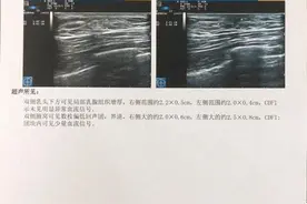 花了上万块，26岁小伙健身3个月乳房发育，还一碰就痛图片