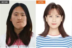 “歪脸女孩”治愈出院，她还做了一个决定图片