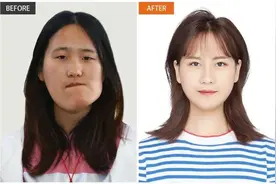 怀揣教师梦的23岁“歪脸女孩”脱胎换骨！整容成功后，她只想做一件事图片