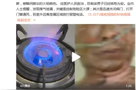 鼻毛都烧焦了！男子用打火机探查煤气管道致烧伤图片