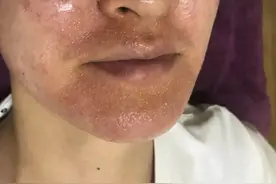 皮肤鸦片！杭州一妙龄女子停用美容院的这款产品后“毁容”了图片