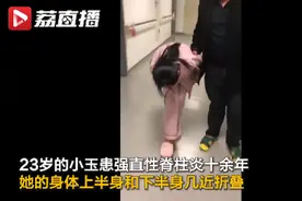 泪目！4次手术折叠女孩终能直立行走：恢复正常后，想自己挣钱养活爸妈图片