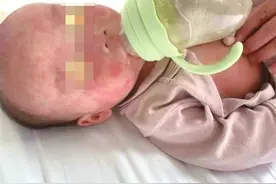 幼儿急疹多可自愈 无需使用抗生素图片