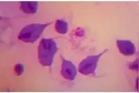 尿道里的“虫”——滴虫性尿道炎图片