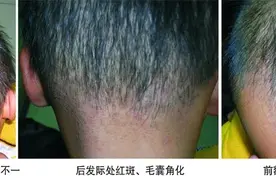念珠状发图片