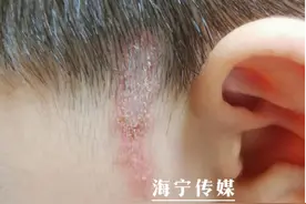 浙江6岁男孩在公园留下一道红印，第二天妈妈一看吓坏了！夏季高发，这"小东西"太危险...图片