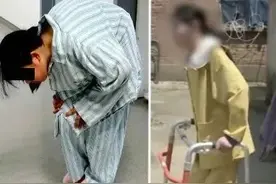 经过4次手术，“折叠女孩”终于可以抬头看到天了图片