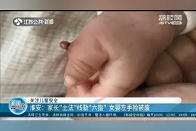 婴儿左手多长出一根指头 家长用“土法”线勒险些废掉整只手图片