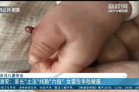 婴儿左手多长出一根指头 家长用“土法”线勒险些废掉整只手图片