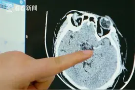 如果只有半个大脑，人生还有多少可能？图片