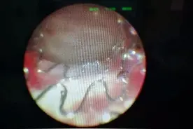 前列腺增生的新式武器图片