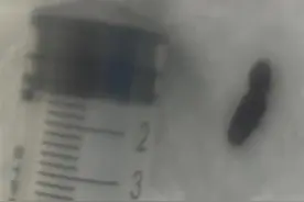 10岁男童深夜总听到异响，竟是耳朵里住着“不速之客”图片