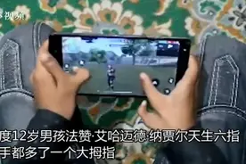 印度12岁男孩天生双手“六指”，自称有助于赢得电子游戏和板球图片