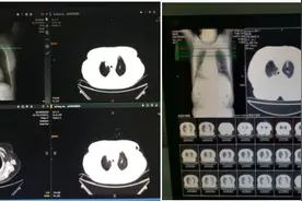 【医疗动态】肿瘤MDT模式提高肿瘤患者生活质量、延长肿瘤患者生存期 ——甘肃省中医院肿瘤防治中心肺穿刺活检确诊1例早期肺癌图片