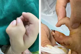一岁男娃拇指似“蟹钳”，医生用绣花功夫妙手矫正图片