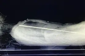 惊险！女子高空坠落被71cm钢筋贯穿，医生却直呼“奇迹”图片