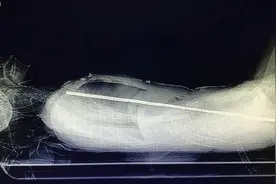 万幸！女子高空坠落身体被71cm钢筋贯穿，惊险生还图片