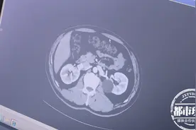 男子这样减肥暴瘦竟患上两种癌症！千万别再这样做了图片