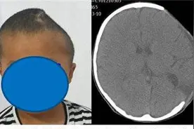 山东省首例！4岁男孩外伤手术救治后颅骨缺损，实现无金属化修补图片
