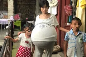 心疼！2年时间女子肚子疯长成巨球，每晚只能坐着睡觉…背后的故事心酸又温暖图片