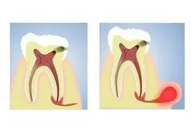 牙肉长脓包，根尖周炎在搞鬼图片