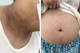 17岁男孩体重228斤，脖子发黑身上异味！医生表示再不减肥就晚了图片